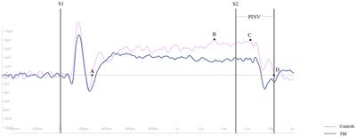 Contingent negative variation as an evaluation indicator of neurocognitive disorder after traumatic brain injury